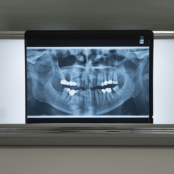Implantologia-Dentale-e-Piezochirurgia
